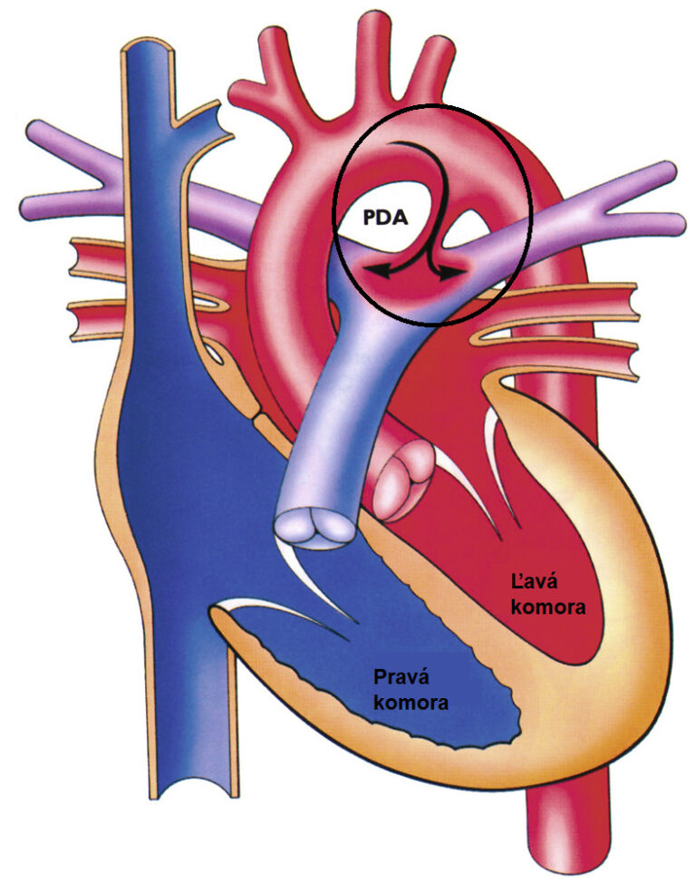 Otvorený ductus arteriosus Botalli - Medicína a chirurgia